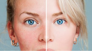 Dealing With Hormonal Acne: How To Recognise And Treat it